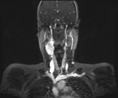 Carotid body tumor (Radiopaedia 12777-12912 MRA 31).jpg