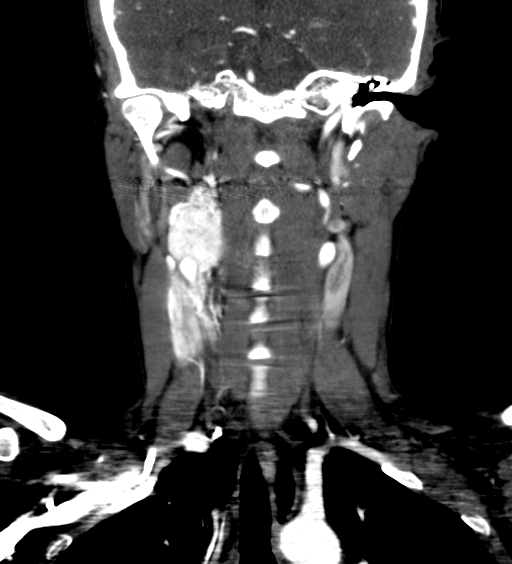 File:Carotid body tumor (Radiopaedia 39845-42300 C 41).jpg
