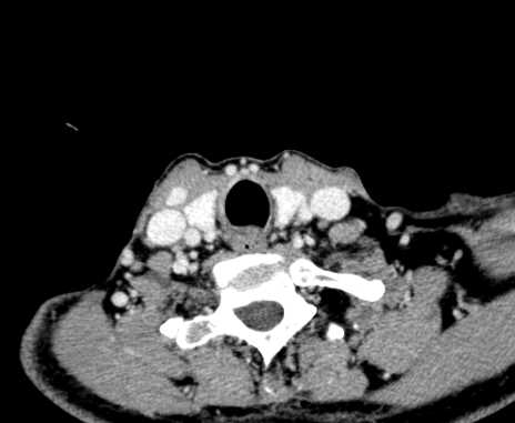 Carotid body tumor (Radiopaedia 61750-69757 Axial Post contrast 97).jpg