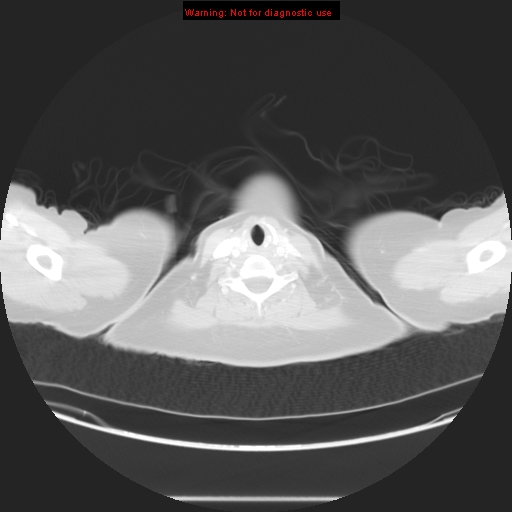 Carotid body tumor with lung metastases (Radiopaedia 9301-48390 Axial lung window 3).jpg