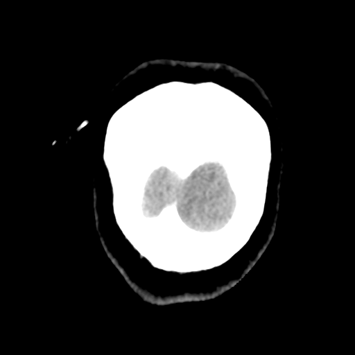 Cavernoma with hemorrhage (Radiopaedia 70755-80931 Coronal non-contrast 60).png