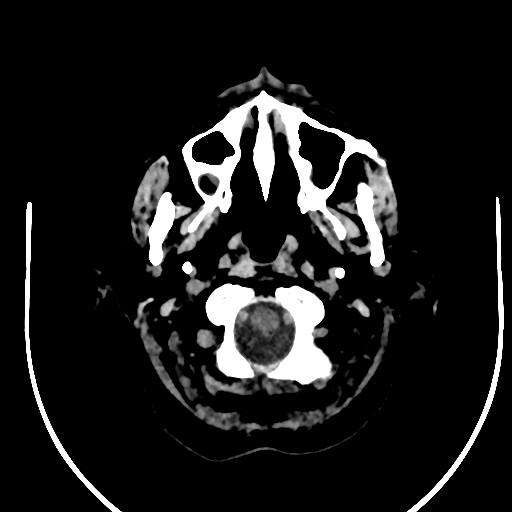 Cavernous hemangioma of the cerebellar falx (Radiopaedia 73025-83723 Axial non-contrast 5).jpg