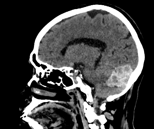 Cavernous hemangioma of the cerebellar falx (Radiopaedia 73025-83723 B 138).jpg