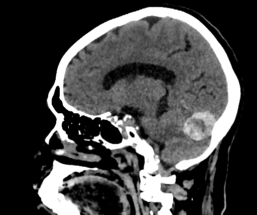 Cavernous hemangioma of the cerebellar falx (Radiopaedia 73025-83723 B 189).jpg