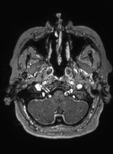Cavernous hemangioma of the cerebellar falx (Radiopaedia 73025-83724 Axial T1 C+ 299).jpg