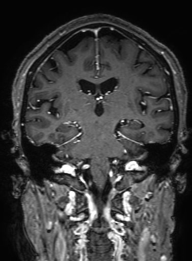 Cavernous hemangioma of the cerebellar falx (Radiopaedia 73025-83724 Coronal T1 C+ 215).jpg