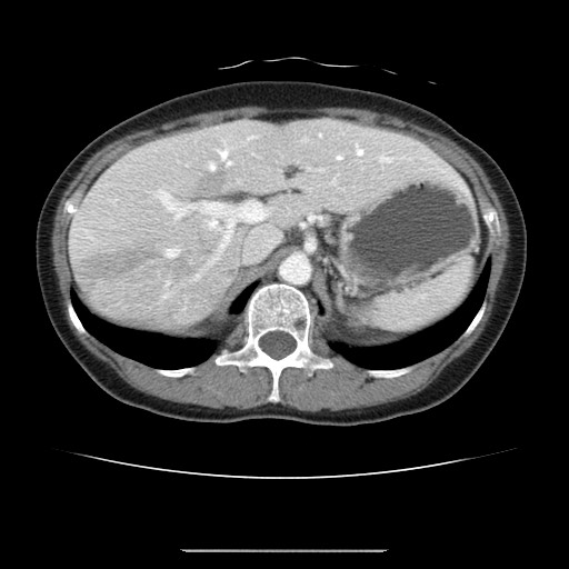 File:Cavernous hepatic hemangioma (Radiopaedia 75441-86667 B 32).jpg