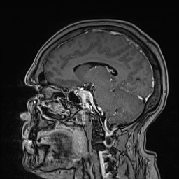 Cavernous sinus meningioma (Radiopaedia 63682-72367 Sagittal T1 C+ 101).jpg