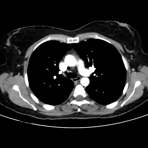 File:Cavitating lung mass - squamous cell carcinoma (Radiopaedia 48047-52854 B 19).png