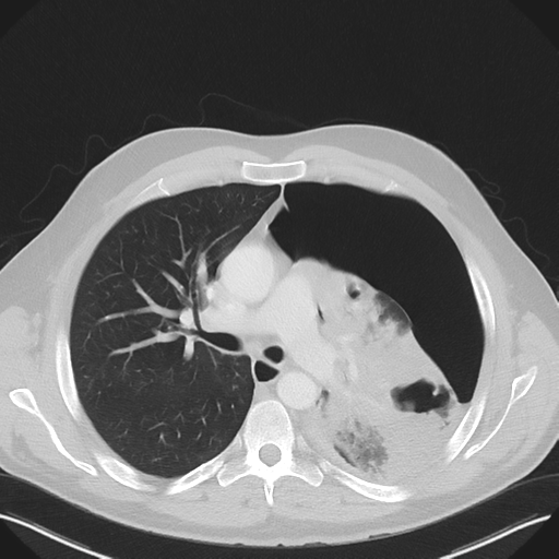 File:Cavitating pneumonia complicated by pneumothorax (Radiopaedia 48149-52994 Axial lung window 29).png