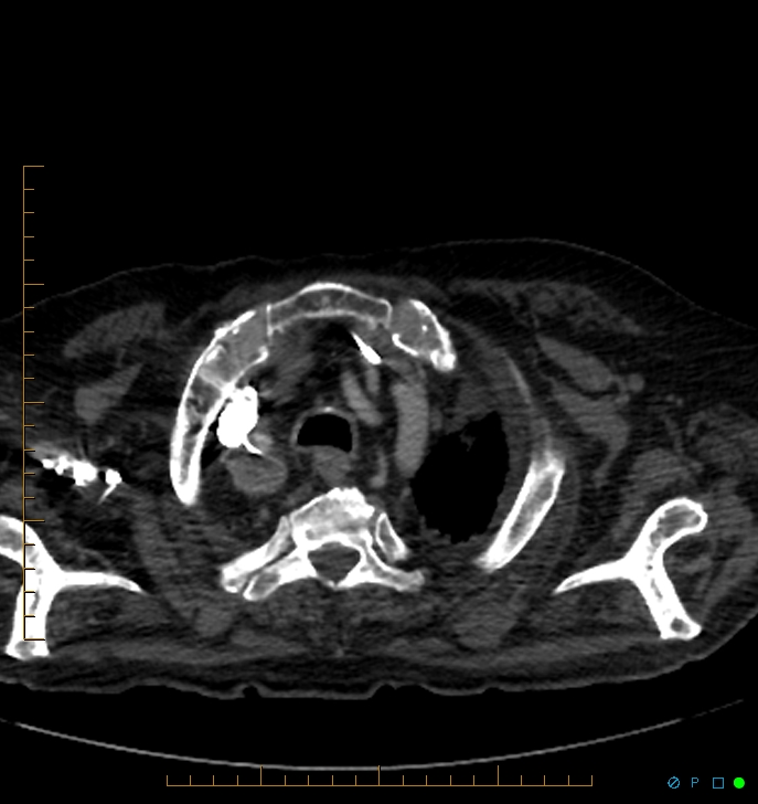Cavitating pulmonary infarction (Radiopaedia 54634-60849 Axial C+ CTPA 1).jpg