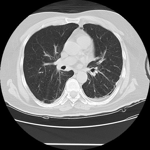 Cavitating pulmonary metastases (Radiopaedia 89545-106544 Axial lung window 29).jpg
