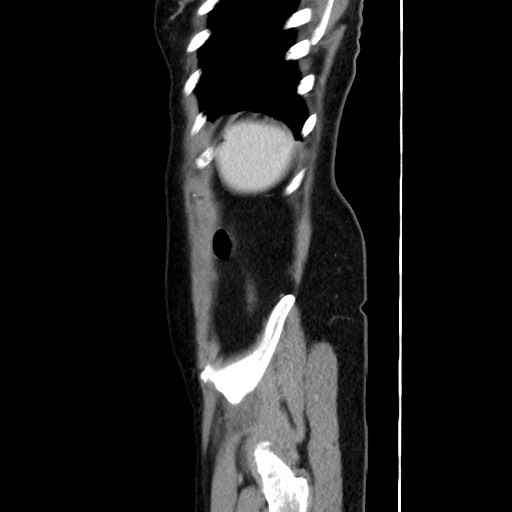 Cecal adenocarcinoma (Radiopaedia 75909-87331 C 61).jpg