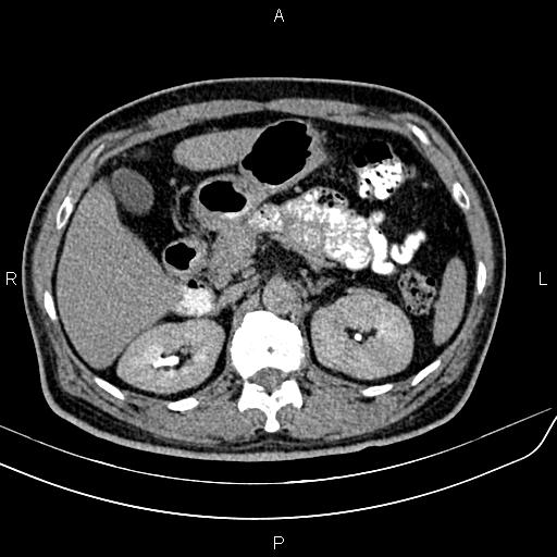 File:Cecal cancer with appendiceal mucocele (Radiopaedia 91080-108651 Axial C+ delayed 15).jpg