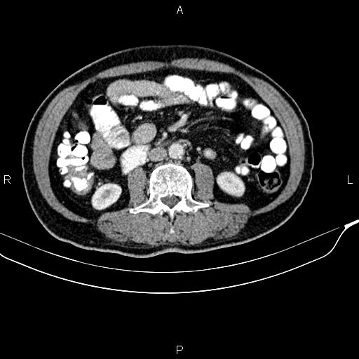 File:Cecal cancer with appendiceal mucocele (Radiopaedia 91080-108651 B 56).jpg