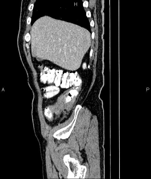 File:Cecal cancer with appendiceal mucocele (Radiopaedia 91080-108651 E 16).jpg