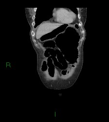 Cecal volvulus (Radiopaedia 86741-102900 B 67).jpg