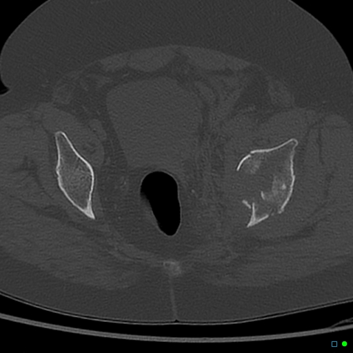 File:Central fracture-dislocation of the acetabulum (Radiopaedia 36578-38150 Axial bone window 50).jpg