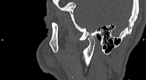 File:Central giant cell granuloma (Radiopaedia 83346-97761 Sagittal bone window 7).jpg