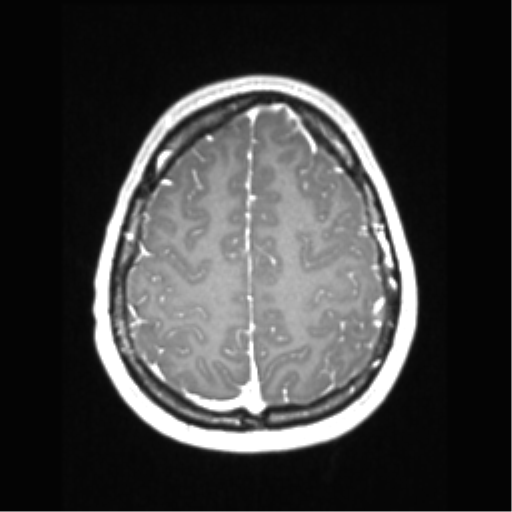 Central neurocytoma (Radiopaedia 37664-39557 Axial T1 C+ 64).png