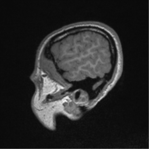 Central neurocytoma (Radiopaedia 37664-39557 Sagittal T1 83).png