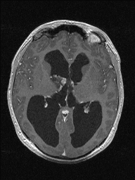 Central neurocytoma (Radiopaedia 56690-63469 Axial T1 C+ 80).jpg