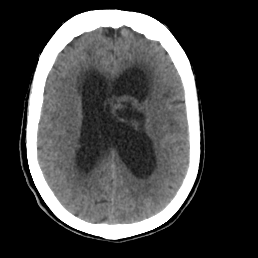 Central neurocytoma (Radiopaedia 65317-74346 Axial non-contrast 31).png