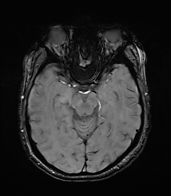 File:Central neurocytoma (Radiopaedia 71068-81303 Axial SWI 22).jpg