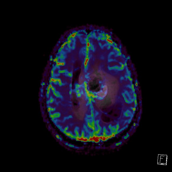 Central neurocytoma (Radiopaedia 84497-99872 Axial Perfusion 99).jpg
