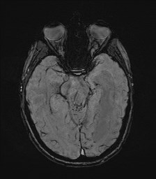 Central neurocytoma (Radiopaedia 84497-99872 Axial SWI 27).jpg