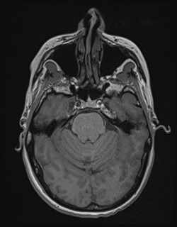Central neurocytoma (Radiopaedia 84497-99872 Axial T1 65).jpg