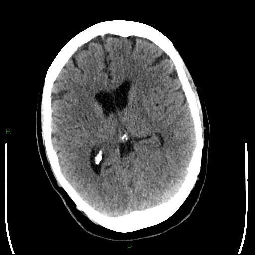 Cerebellar abscess (Radiopaedia 78135-90671 Axial non-contrast 59).jpg
