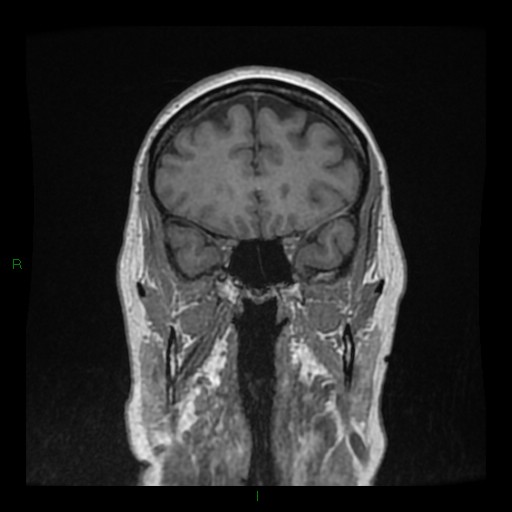 Cerebellar abscess (Radiopaedia 78135-90678 Coronal T1 C+ 49).jpg