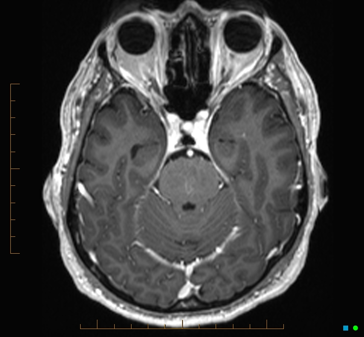 Cerebellar gangliocytoma (Radiopaedia 65377-74422 Axial T1 C+ 39).jpg