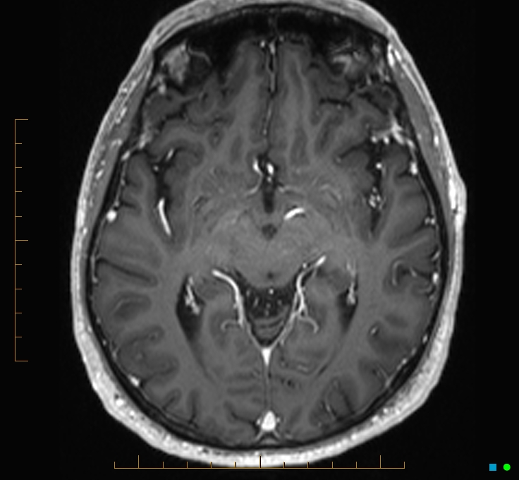 Cerebellar gangliocytoma (Radiopaedia 65377-74422 Axial T1 C+ 57).jpg