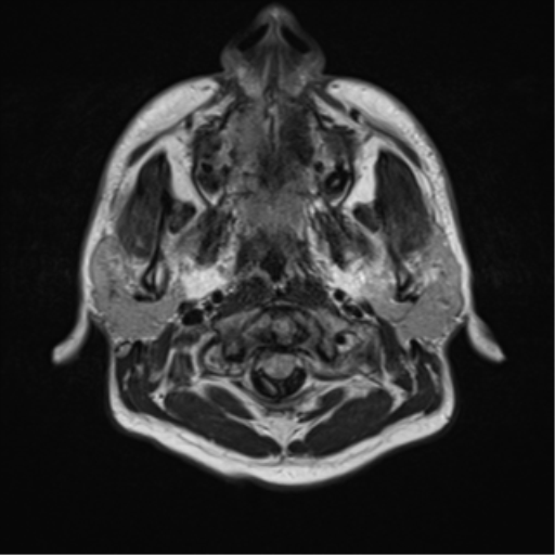 File:Cerebellar hemangioblastomas and pituitary adenoma (Radiopaedia 85490-101176 Axial FLAIR 1).png