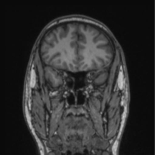 Cerebellar hemangioblastomas and pituitary adenoma (Radiopaedia 85490-101176 Coronal T1 66).png