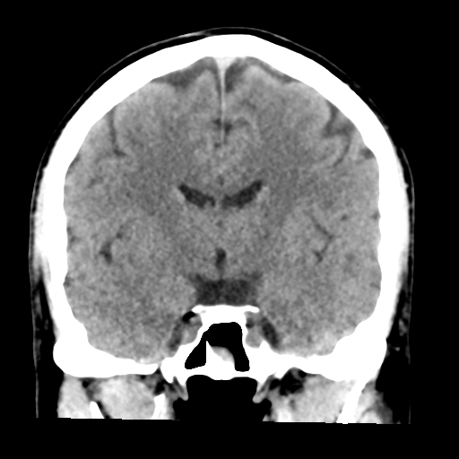 File:Cerebellar hemorrhage (Radiopaedia 37000-38669 Coronal non-contrast 23).png