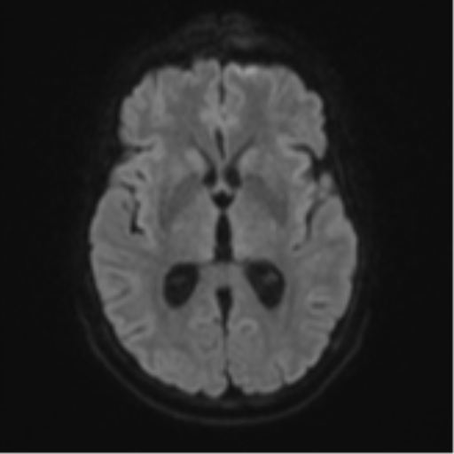 Cerebellar metastasis (Radiopaedia 51137-56765 Axial DWI 43).png