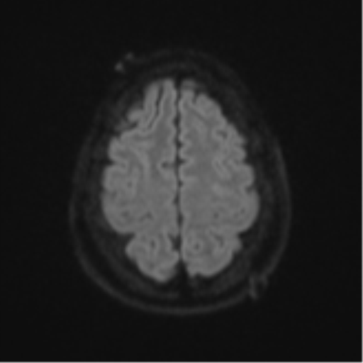 Cerebellar metastasis (Radiopaedia 51137-56765 Axial DWI 51).png