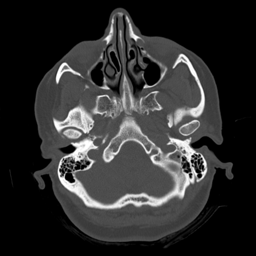 Cerebellar metastasis (cystic appearance) (Radiopaedia 41395-44258 Axial bone window 9).png