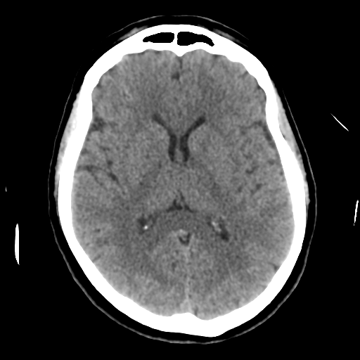 Cerebellar metastasis (cystic appearance) (Radiopaedia 41395-44258 Axial non-contrast 29).png