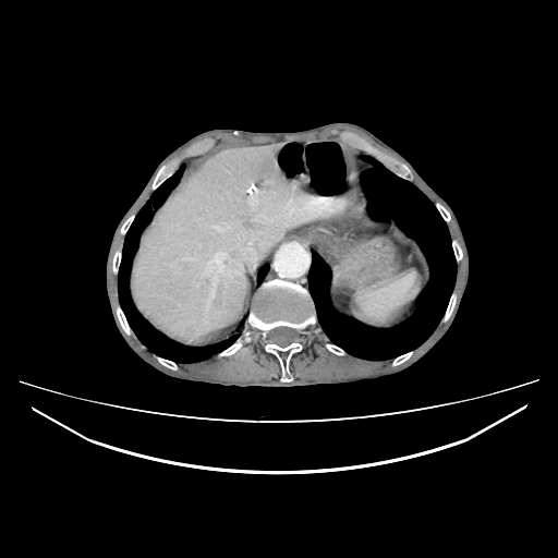 File:Cerebellar metastasis - lung tumor (Radiopaedia 69317-79150 A 34).jpg