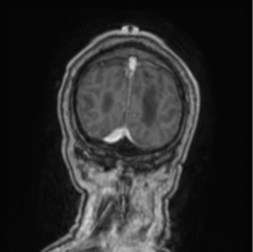 Cerebellar metastasis from lung adenocarcinoma (Radiopaedia 86690-102829 Coronal T1 C+ 11).png