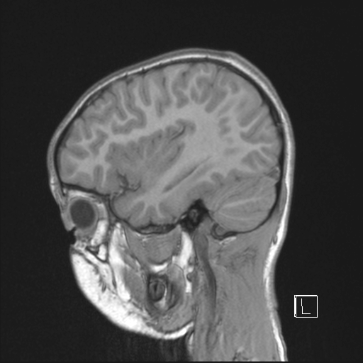 File:Cerebellar stroke (Radiopaedia 32202-33150 Sagittal T1 C+ 13).png
