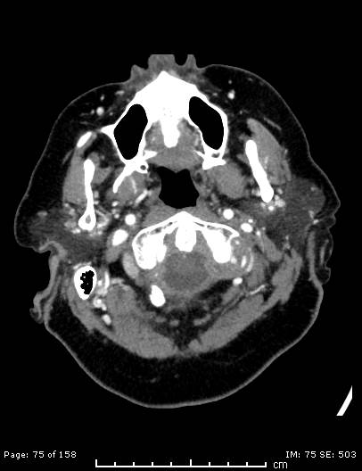 Cerebellar strokes due to intracranial giant cell arteritis (Radiopaedia 68799-78510 CT angiogram 75).jpg
