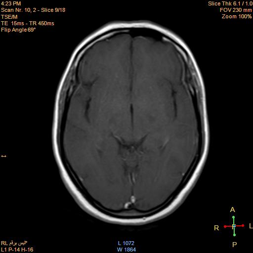 File:Cerebellopontine angle meningioma (Radiopaedia 22488-22525 Axial T1 C+ 8).jpg