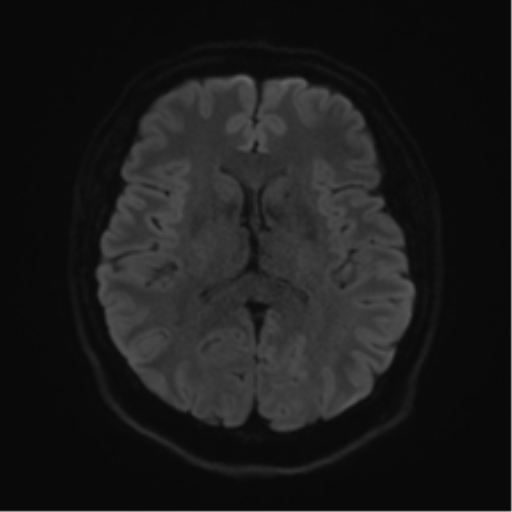 Cerebellopontine angle meningioma (Radiopaedia 48434-53348 Axial DWI 58).png