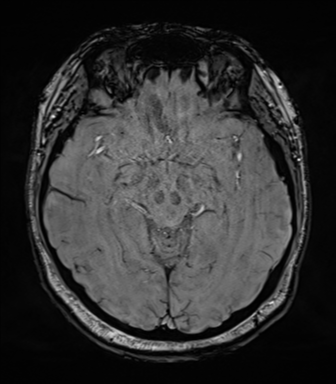 Cerebellopontine angle meningioma (Radiopaedia 48434-53348 Axial SWI 40).png