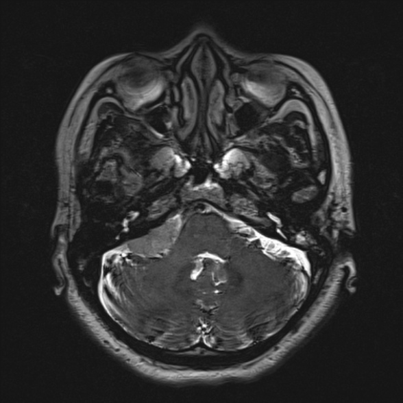 Cerebellopontine angle meningioma (Radiopaedia 53561-59591 Axial 3D volume T2 51).jpg